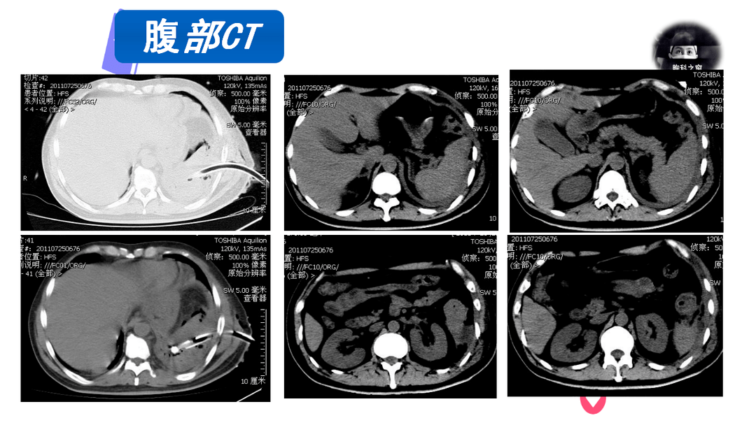 陰性ppd弱陽性,抗結核抗體陰性g試驗:陰性tb-spot:陰性留觀超聲心動