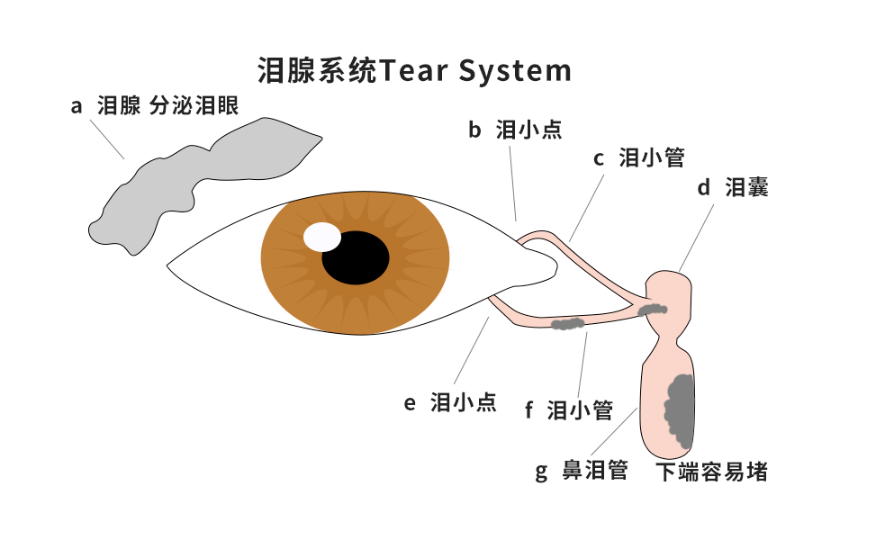 淚道阻塞是指淚小點,淚小管,鼻淚管及鼻淚管下口由各種原因而發生阻塞