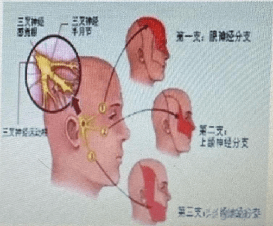 病例分享丨一例三叉神經半月節球囊壓迫術麻醉的思考