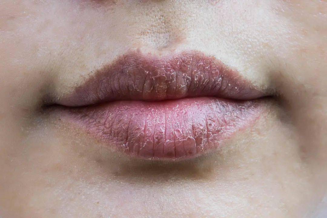 要知道,嘴唇的角质层比脸还薄,在干燥季节,咱们就更要注意护理