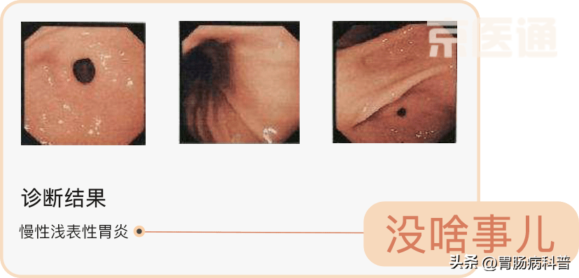 胃鏡檢查全攻略(收藏版)_食管_幽門_患者